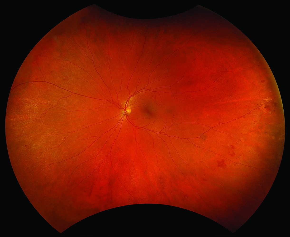 Optos educational example of an ultra-widefield retinal image